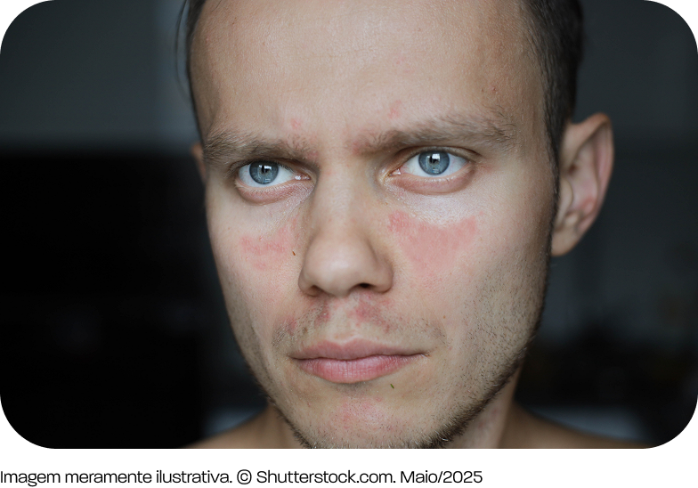 Foto de um homem apresentando as marcas da doença na face